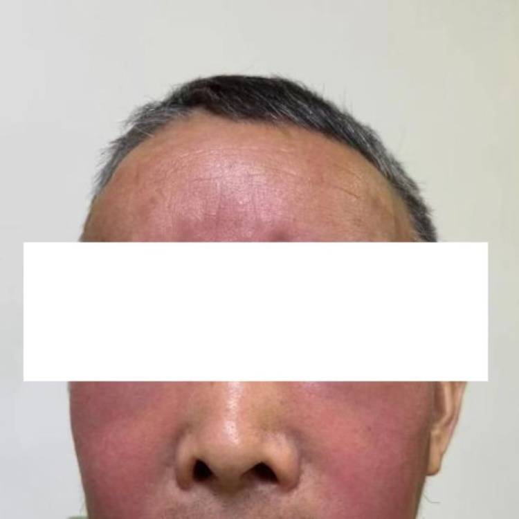 杭州发生多起!面部肿成“馒头”!6小时内处理很重要