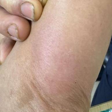 杭州发生多起!面部肿成“馒头”!6小时内处理很重要