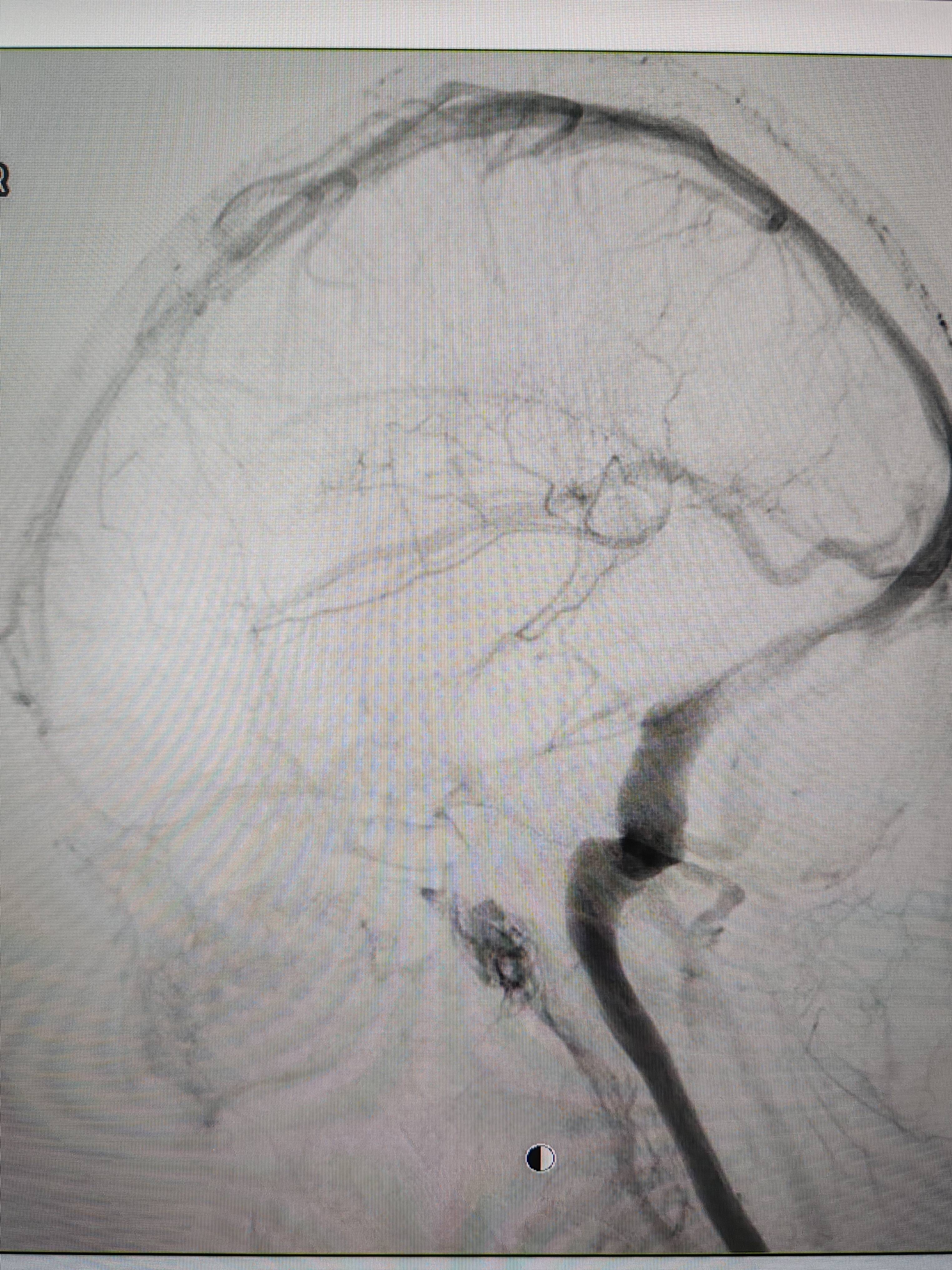 吉林女子患罕见耳鸣7年,慕名千里来顺德寻医终获新生
