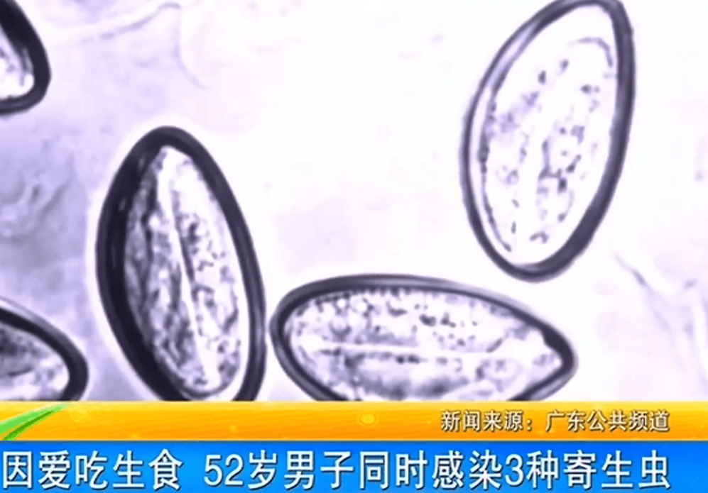 女子体内排出10米长绦虫!原是两年前旅游时吃了这种食物