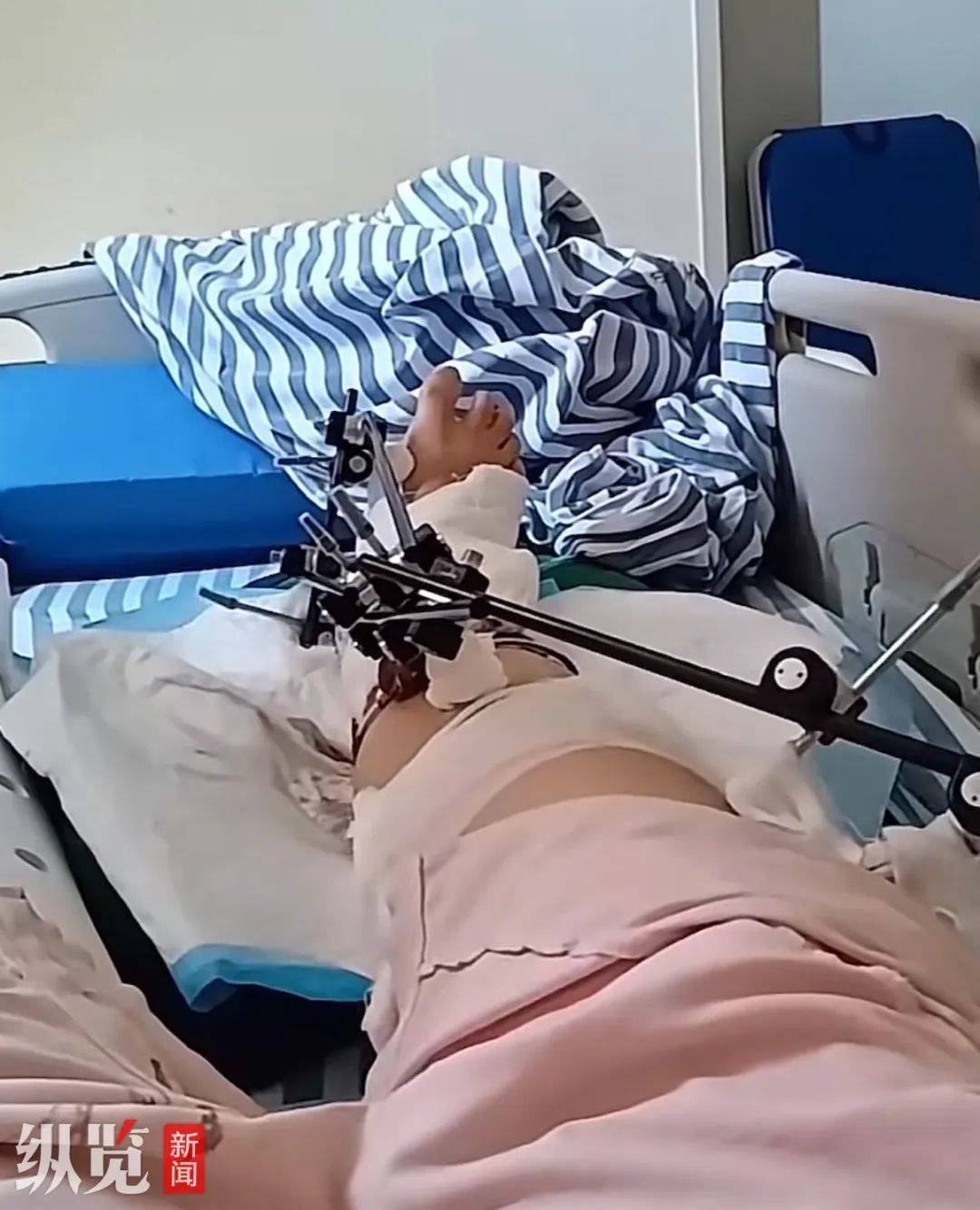 江西一女子从12楼坠落奇迹生还！当事人还原细节：即将落地时先接触到车棚，若第二次手术成功，半年后就可恢复正常