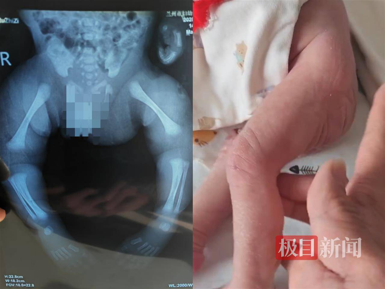 二胎出生查出先天性病症或落下残疾,残疾父母称医院产检漏检、未尽告知义务,医院及医调委回应