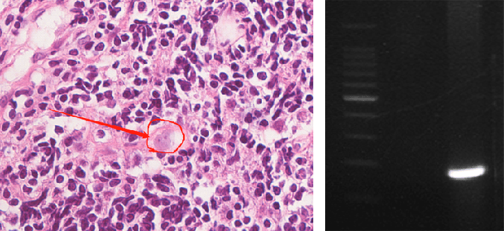 上海确诊1例！张文宏团队参与会诊！病死率极高，发病一周内迅速恶化